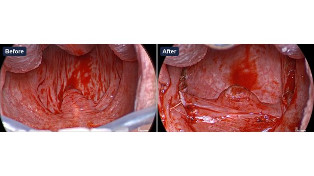 The inlet before and after repositioning, operative photograph