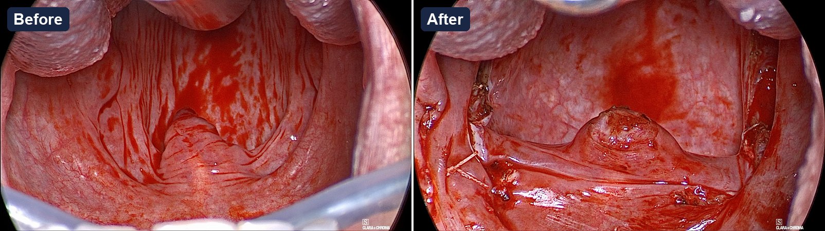 Two endoscopic views of the oropharyngeal inlet through the mouth, labeled Before and After. Before: folded mucosa of the lateral walls and pillars crowds toward the uvula at the center, narrowing the inlet. After: a short trimmed uvula sits at the center of a straight palatal edge, the pillars are pulled outward with suture visible at both sides, and a broad view of the posterior pharyngeal wall opens behind the palate.