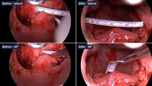 Measuring the airway before and after, operative photograph