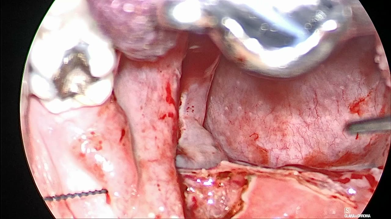 Left tonsillar fossa closed by the repositioned left palatopharyngeus, with the barbed suture exiting at the left lateral palate