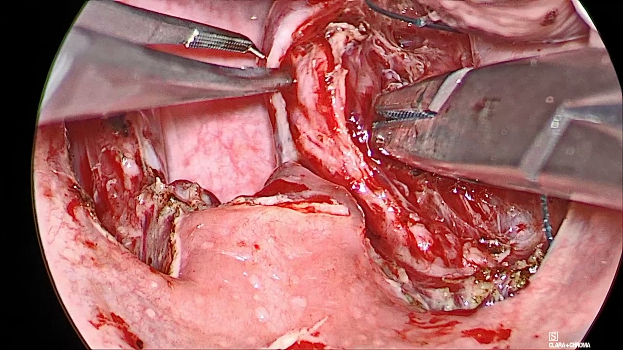 Forceps lifting the released right palatopharyngeus as a band while a needle driver passes a barbed suture deep to it