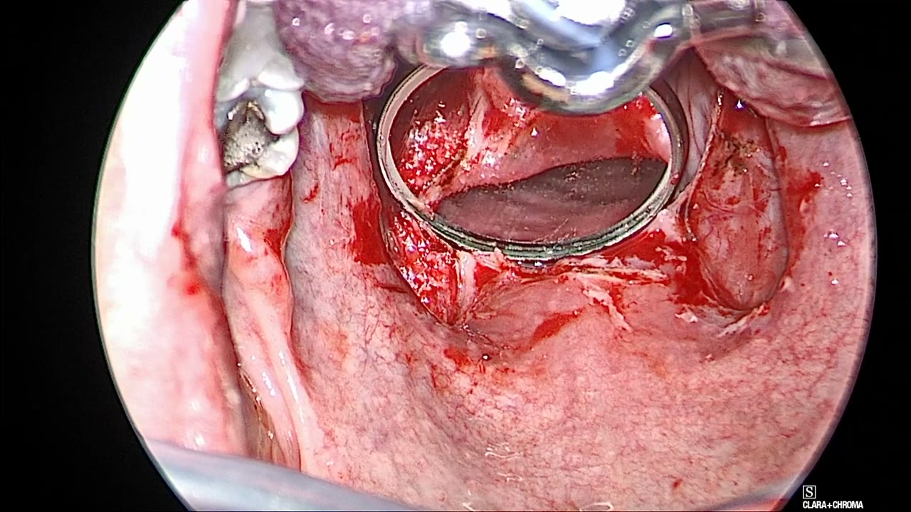 Both tonsillar fossae empty after tonsillectomy, with a round mirror passed behind the soft palate