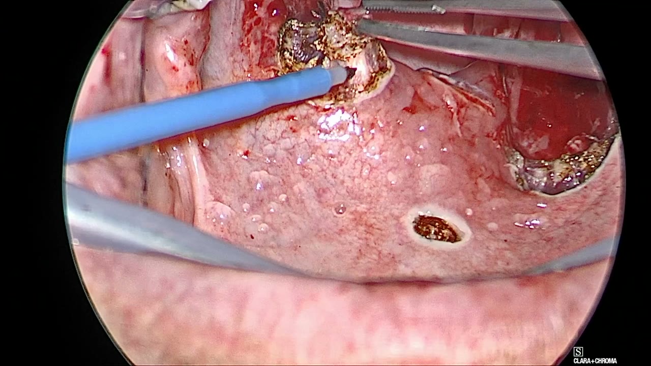 Needle-point Bovie with a blue handle making a small opening at the corner of the left fossa, with the midline opening already made