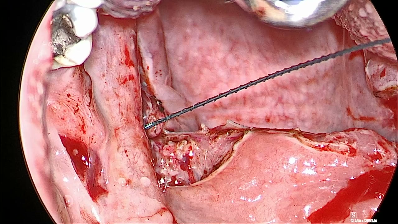 Barbed suture passing through the superior edge of the left posterior pillar near the soft palate