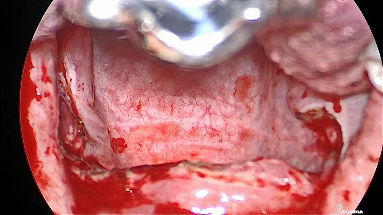 Widened oropharyngeal inlet at the end of the case, with the repositioned pillars drawn laterally