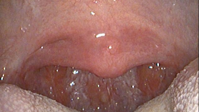 Healed result, operative photograph