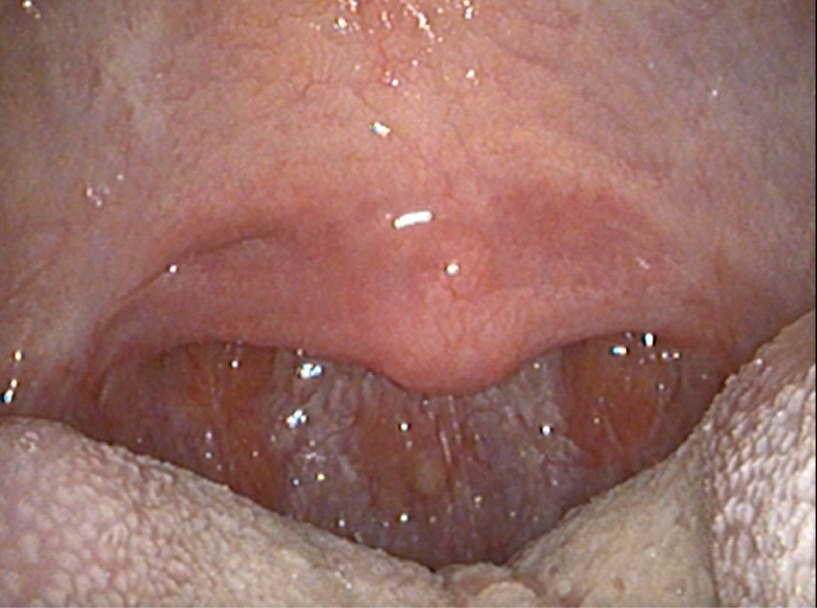 Close transoral view of a healed soft palate forming a smooth, broad arch with a short uvula at its center, a wide opening to the back wall of the throat behind it, and the tongue along the bottom edge.