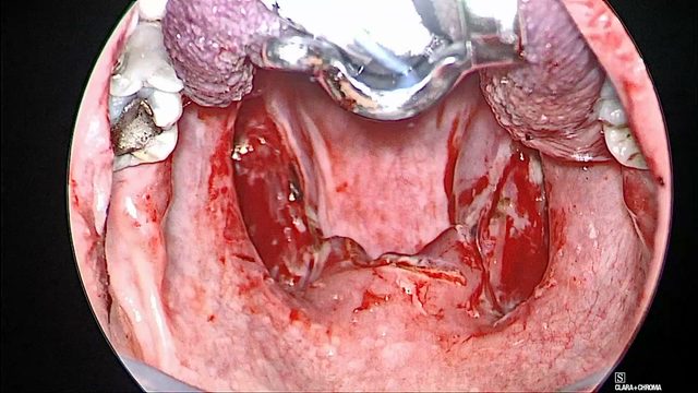 Both sides released, before the first suture, operative photograph
