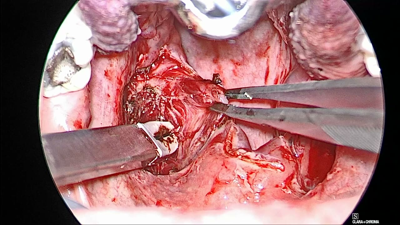 Left posterior tonsillar pillar retracted medially by forceps while the BiZact works in the left fossa