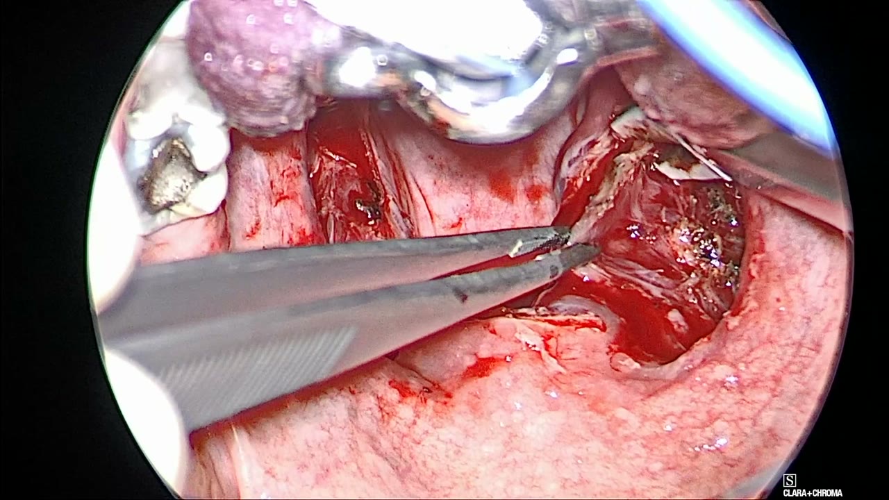 Forceps pulling the right posterior tonsillar pillar medially while the BiZact works lateral to it in the fossa