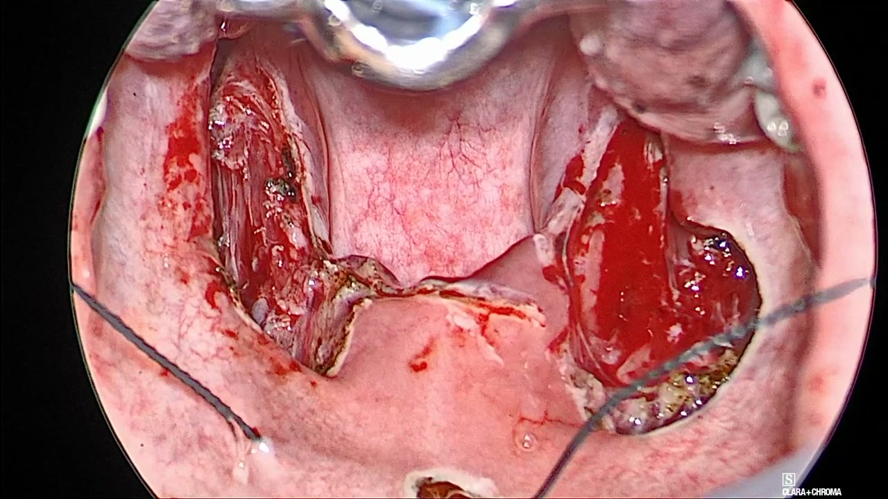 Both barbed suture arms running out toward each side of the soft palate, with the midline window at the bottom of the image and both tonsillar fossae open