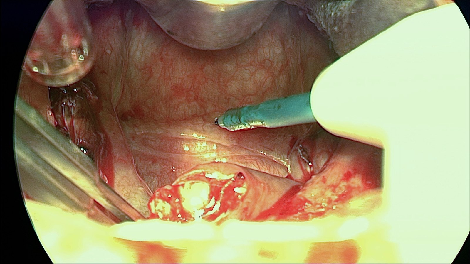 Transoral view with the mouth-gag blade at the top. A needle-point cautery with a teal insulated tip touches a taut, glistening horizontal ridge of mucosa in the center of the field. A raw, trimmed stump of tissue sits at the bottom center, a metal instrument enters from the left, a gloved finger fills the right side, and the lower field is overexposed.