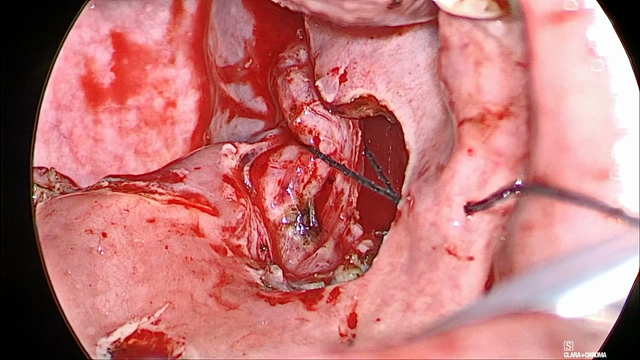Right palatopharyngeus encircled by the barbed suture, with the suture exiting at the right lateral palate