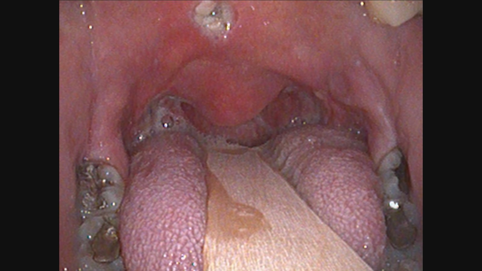 Transoral photograph of an open mouth with a wooden tongue depressor on the tongue. White-gray fibrin lines both tonsillar fossae on either side of a broad soft palate arch, and a small white spot sits high on the midline palate.