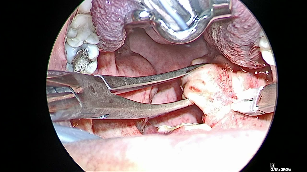 Curved grasper from the left of the image pulling the right tonsil medially while the BiZact dissects along its capsule, with the mouth-gag blade at the top of the image