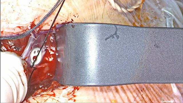 A fixation suture through the suture tab, operative photograph