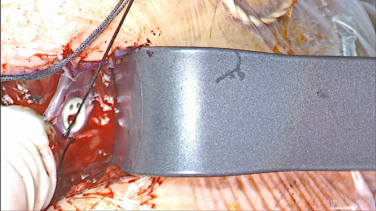 A dark fixation suture passes through a white implant tab with two round holes and a curved slot, beside a large retractor.