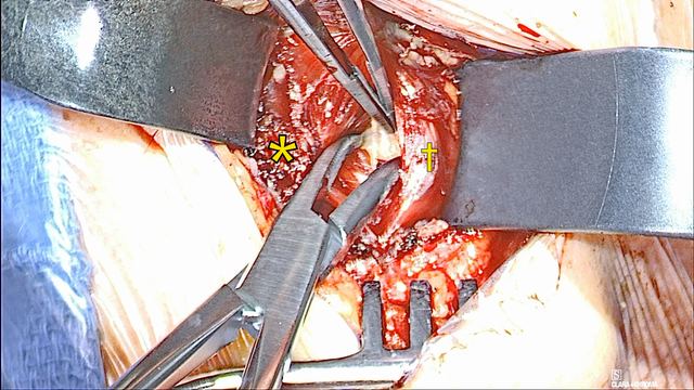 Separating the geniohyoid at the raphe, operative photograph