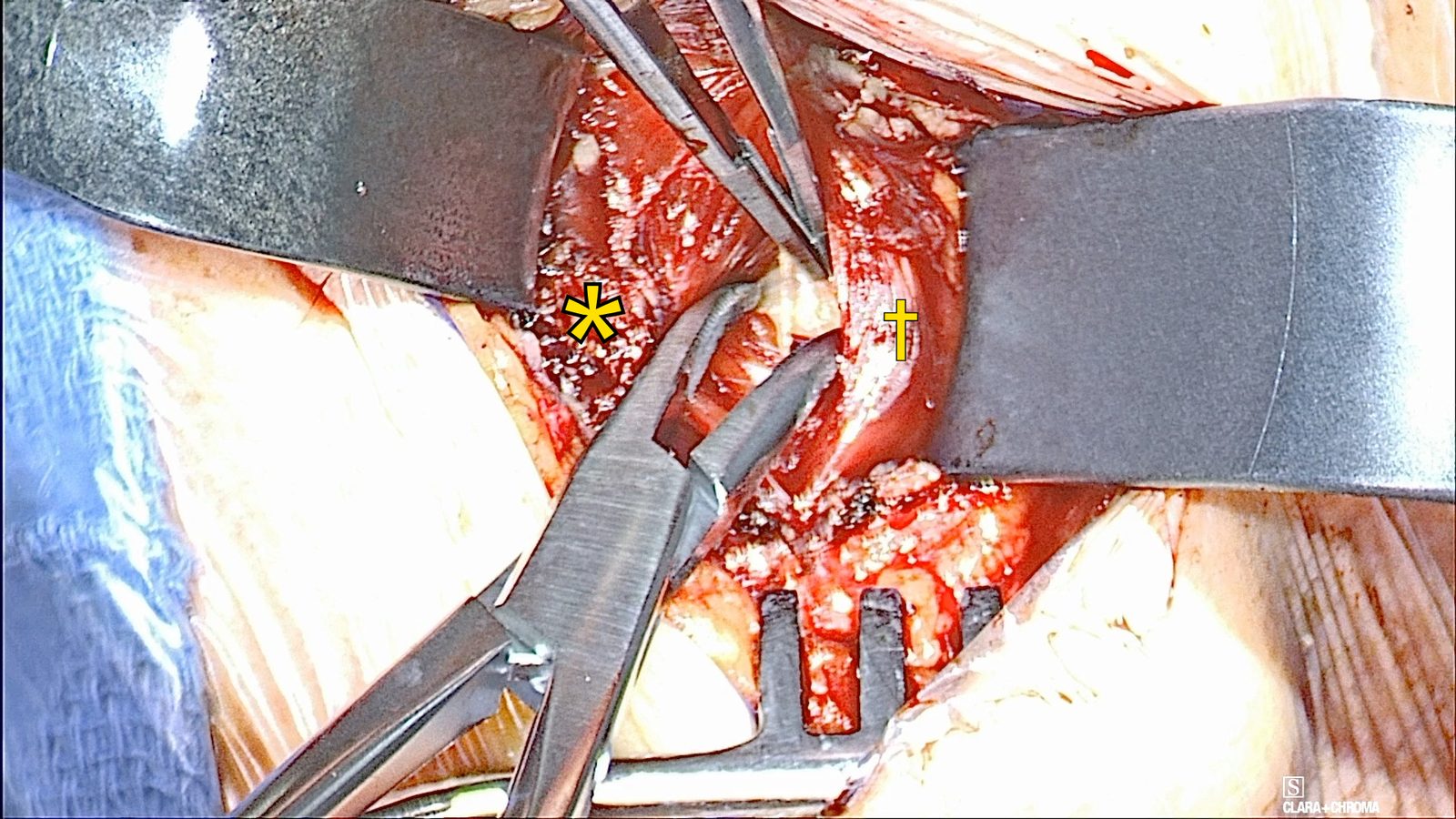 Retractors hold the divided mylohyoid, marked with a yellow asterisk, while curved scissors and a clamp open the midline raphe of the geniohyoid, marked with a yellow dagger.