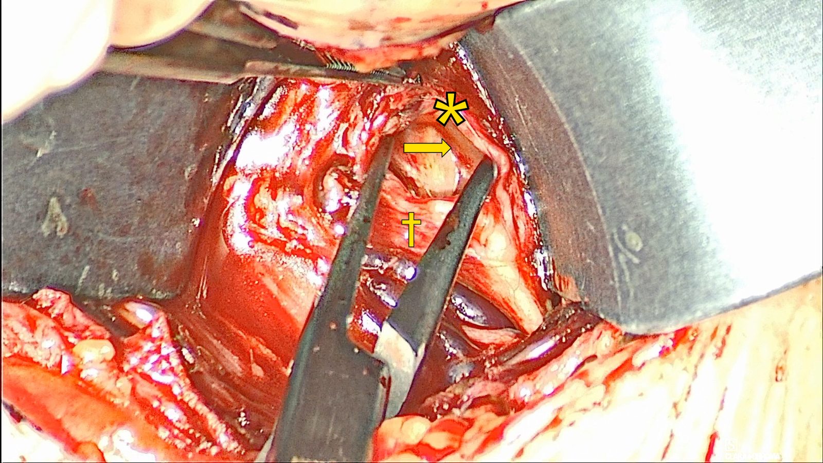 Close view of the left hypoglossal branches with forceps; a yellow arrow points to the hyoglossus edge, a yellow asterisk marks the retrusor branches, and a yellow dagger marks the protrusor branches.