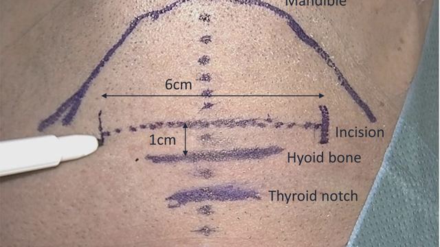 Surface landmarks and the planned incision, operative photograph