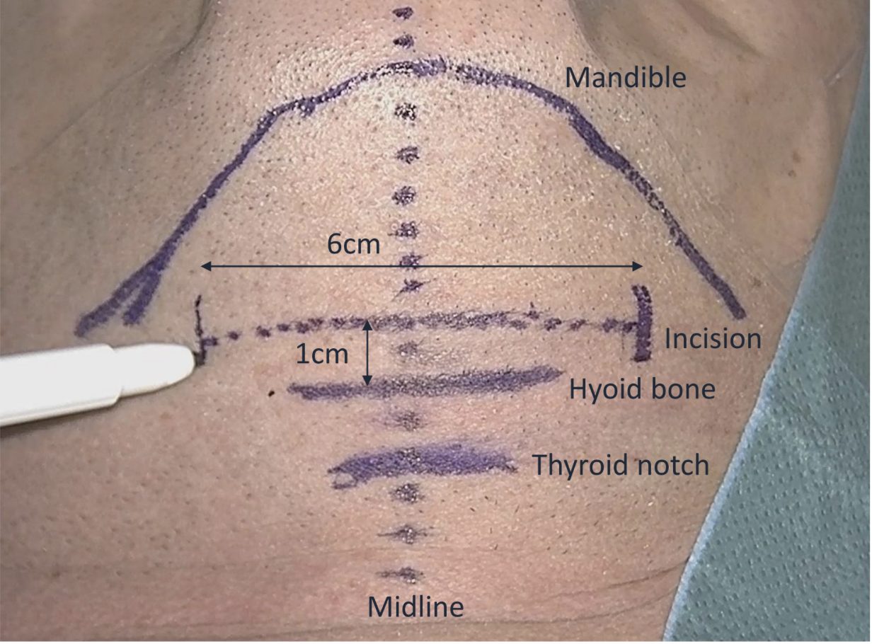 Marked submental skin showing the curved line of the mandible, a dashed 6 cm incision line 1 cm above the marked hyoid bone, the thyroid notch below it, and a dotted midline.