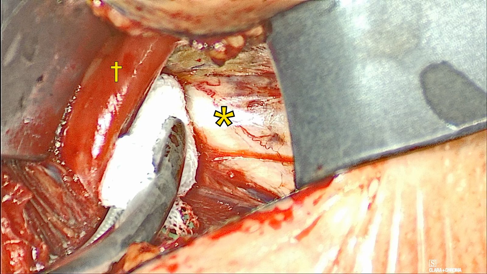 Left-side exposure with a white pledget and a retractor; a yellow dagger marks the left genioglossus and a yellow asterisk marks the left hypoglossal nerve lateral to it.