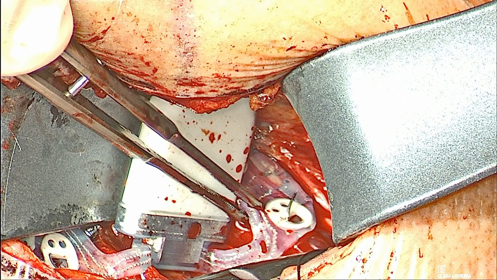The white Genio implant held with forceps during placement of its left paddle, with the paddle’s suture tab visible in the pocket.