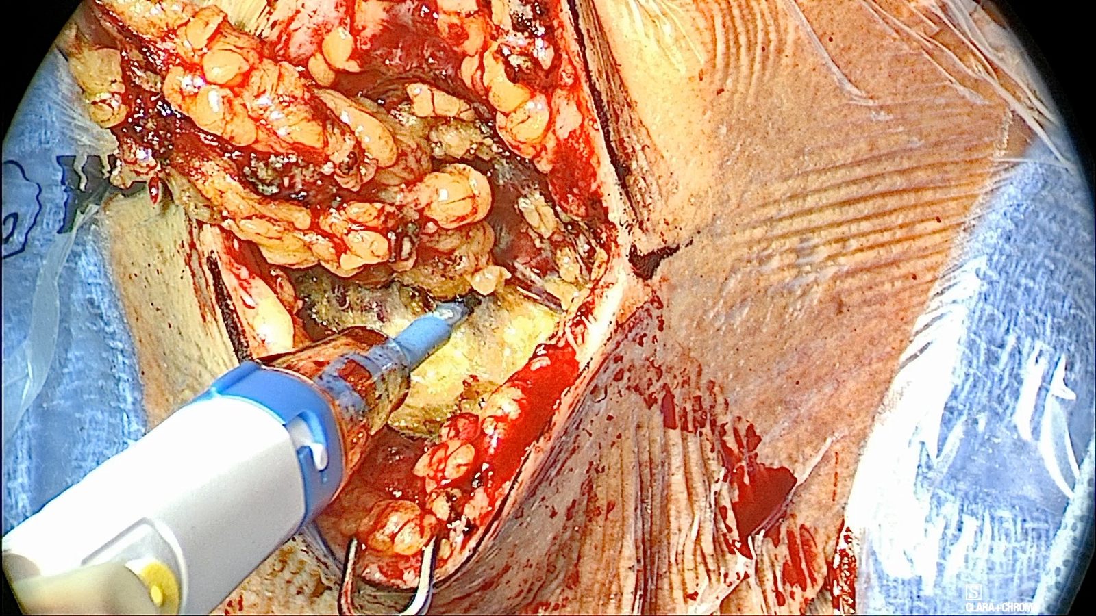 Submental exposure with the skin flaps retracted and an electrocautery pencil clearing yellow level IA fat from the surface of the mylohyoid.