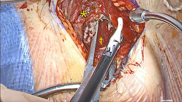 Mylohyoid divided over the geniohyoid, operative photograph