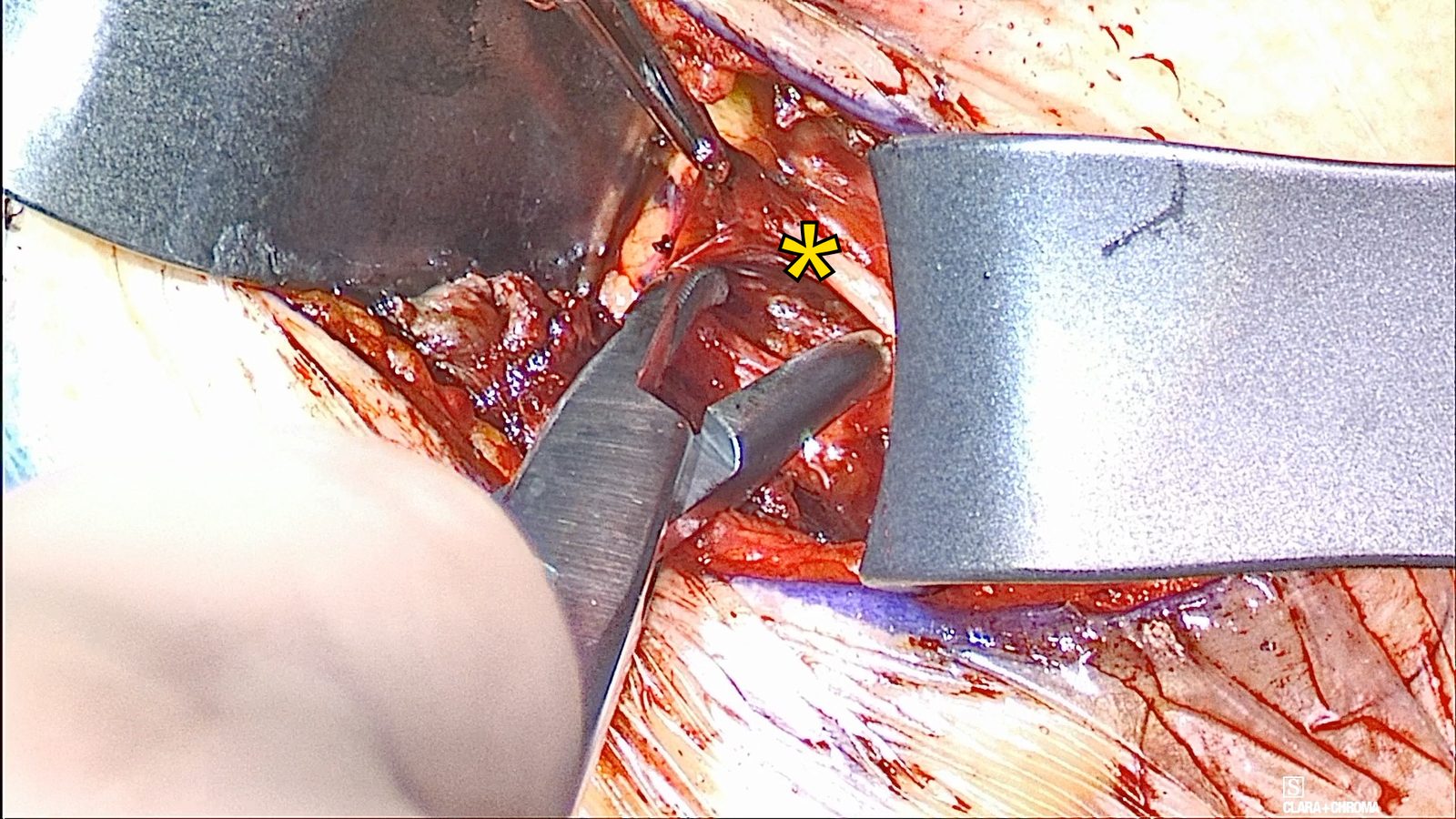 Scissors dissect beside the right hypoglossal nerve, marked with a yellow asterisk, between two retractors.