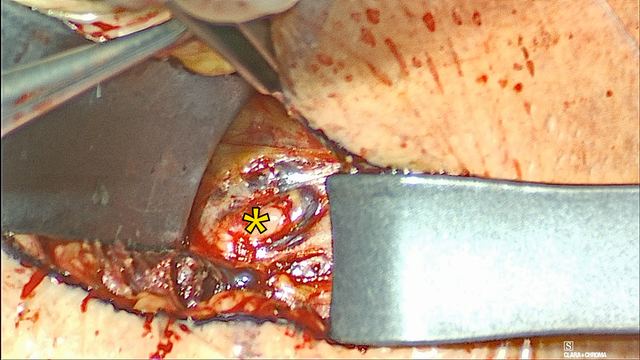 Exposing the right hypoglossal nerve, operative photograph