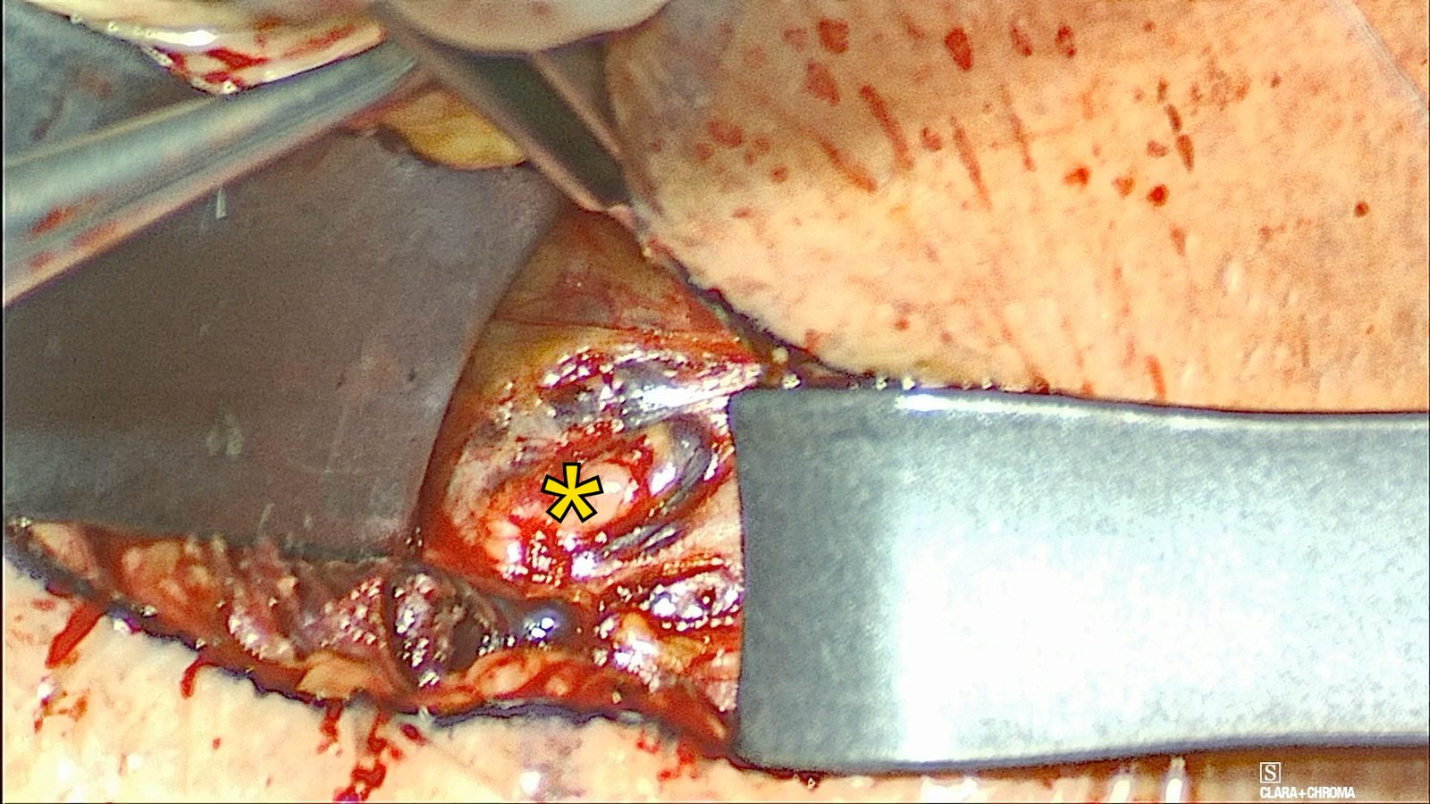 Deep submental view between two retractors; a yellow asterisk marks the right hypoglossal nerve exposed in the fat lateral to the genioglossus.