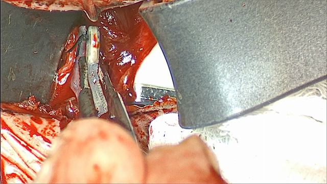 Placing the right paddle, operative photograph
