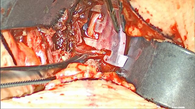 The Surgical Template in the pocket, operative photograph