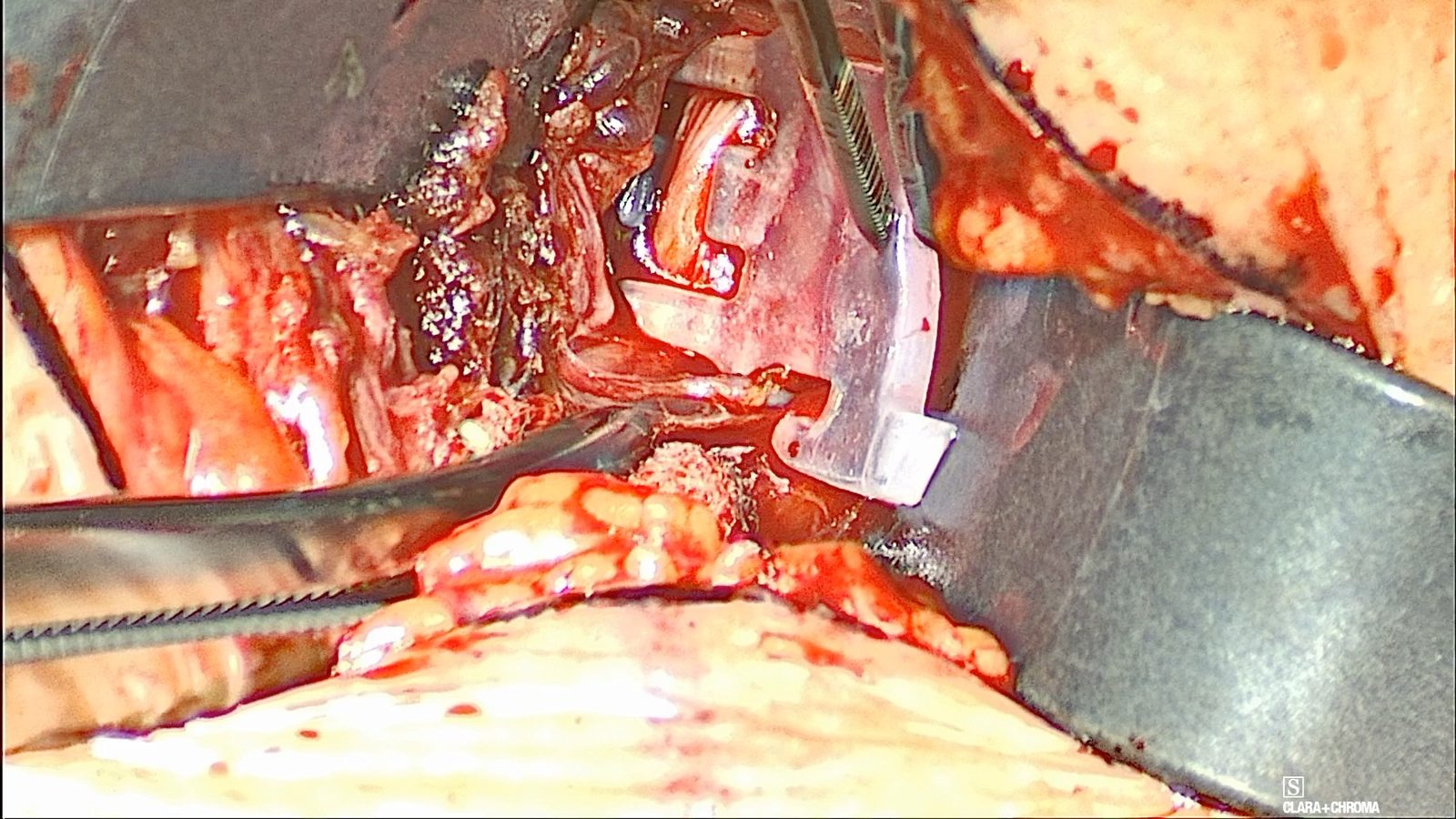 The clear Genio Surgical Template seated in the pocket and held with forceps, with the right hypoglossal nerve visible through its electrode window.