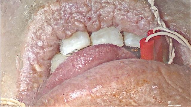 Tongue response during AC/DP testing, operative photograph