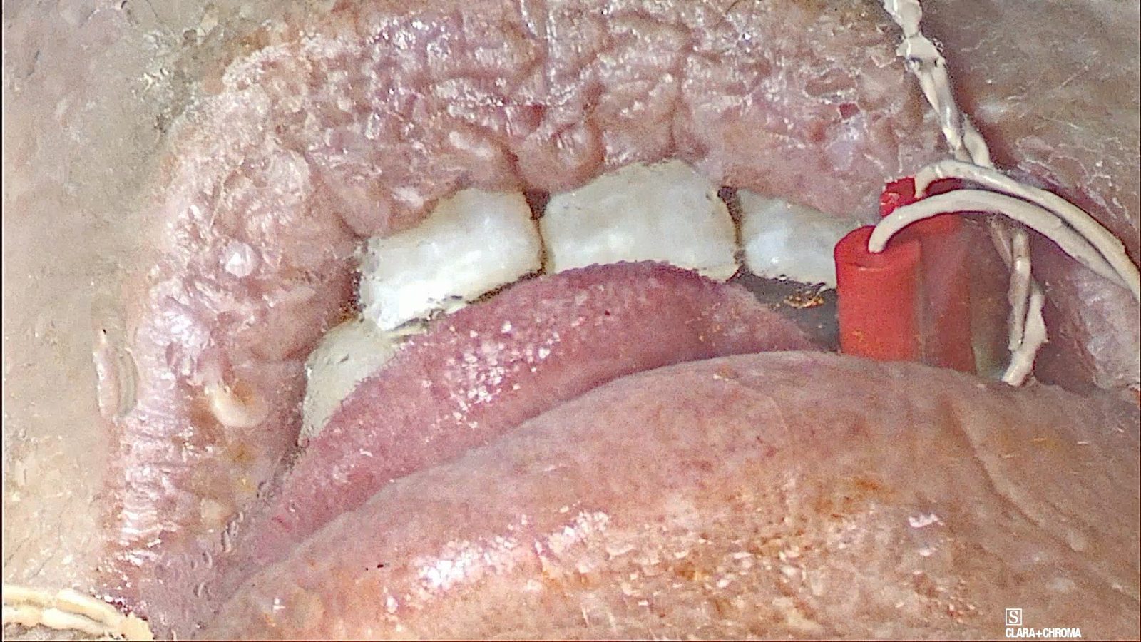 Close view of the mouth during testing, with the tongue protruding forward and monitoring wires at the corner of the mouth.