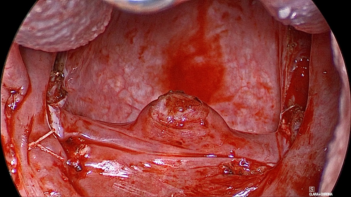 Endoscopic view of the same airway immediately after barbed reposition pharyngoplasty, showing a visibly wider retropalatal space