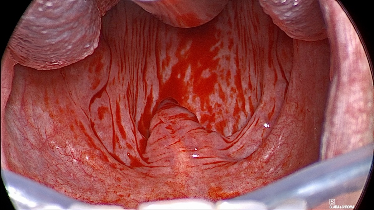 Endoscopic view of the airway at the level of the soft palate before barbed reposition pharyngoplasty, showing a narrow retropalatal space