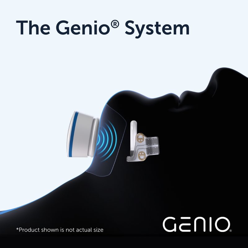 Diagram of the Genio system in profile: the external activation chip rests on the skin under the chin and sends energy through the skin to the implanted stimulator, which sits beneath the chin and straddles the nerve branches on both sides.