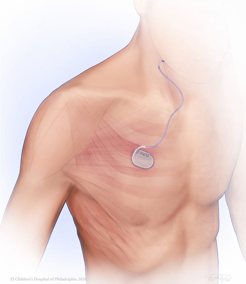 Medical illustration of the Inspire system in place: the small pulse generator sits under the skin of the upper chest below the collarbone, with a thin lead running up toward the neck