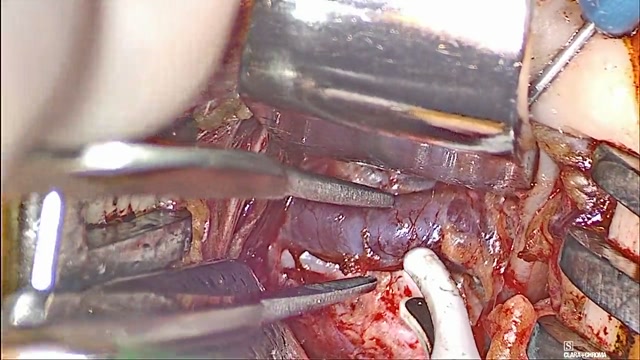 Crossing vein isolated with instruments during the CoolSeal teaching video