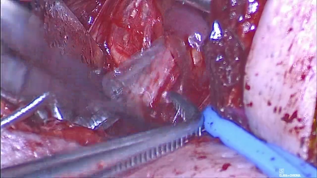 Cuff handling and seating in operative teaching footage