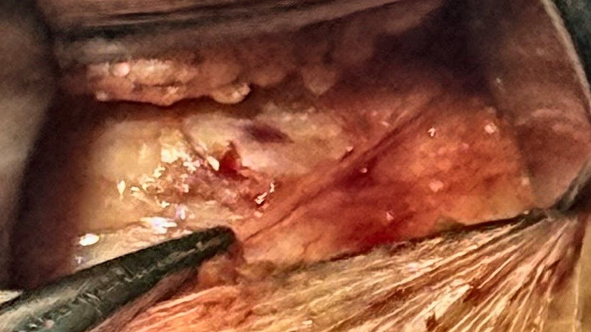 Close view of a small neck incision held open by two retractors, with a fine instrument pointing to a cervical branch of the facial nerve on the surface of the submandibular gland.