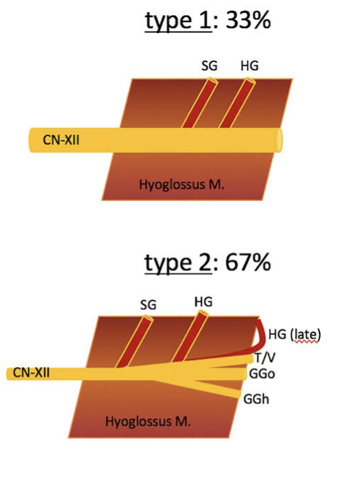 Heiser-based schematic from slide 29 comparing type 1 final hyoglossus branching in 33% of cases with type 2 in 67%, where a late HG branch turns back toward the hyoglossus.
