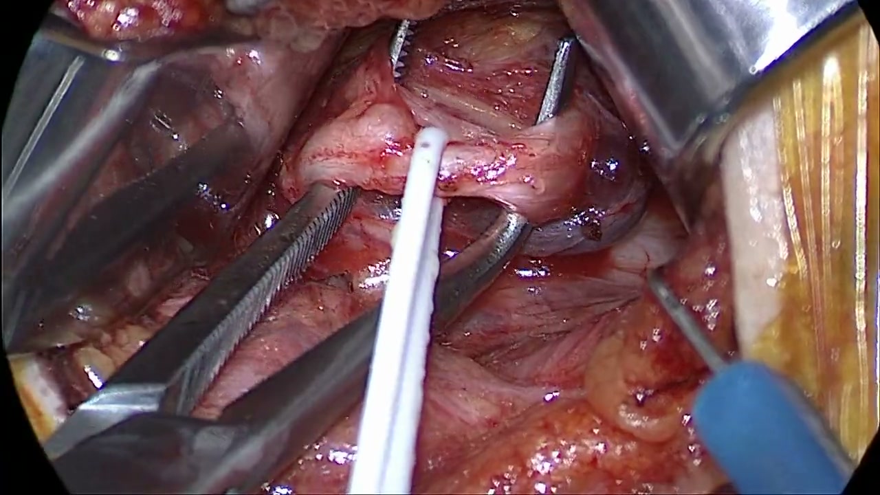 Inspect beneath the nerve in operative teaching footage