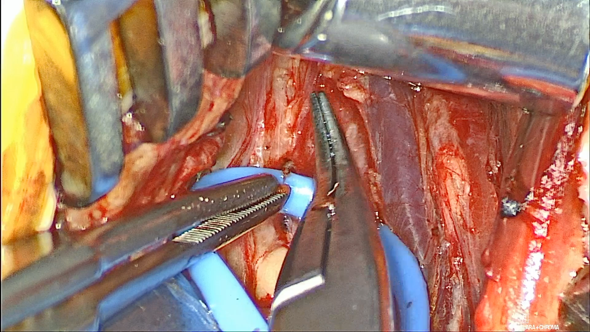 Linz slide 31 operative view of the hypoglossal nerve and the anterior hyoglossus edge during distal branch dissection