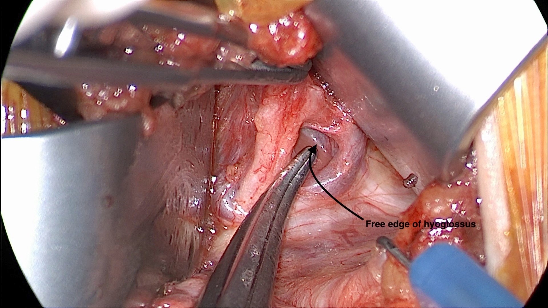 Operative photograph between two retractors: the tip of a forceps rests at the free anterior edge of the hyoglossus muscle, marked by a black arrow and the label “Free edge of hyoglossus.”