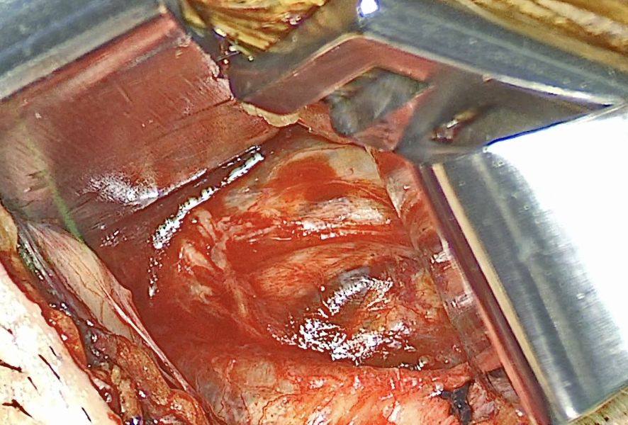 Operative photograph showing an intermediate thickness of fascia over the hypoglossal nerve.